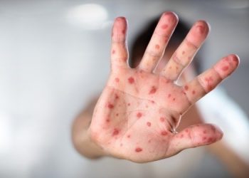 П’ятеро дітей захворіли на кір в Чорткові