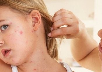 Черговий циклічний підйом захворюваності на кір цього року прогнозують на Тернопільщині