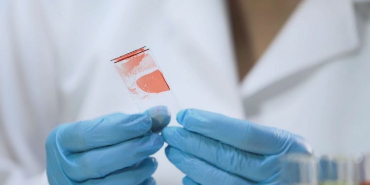 Випадок гепатиту А зафіксували на Тернопіллі